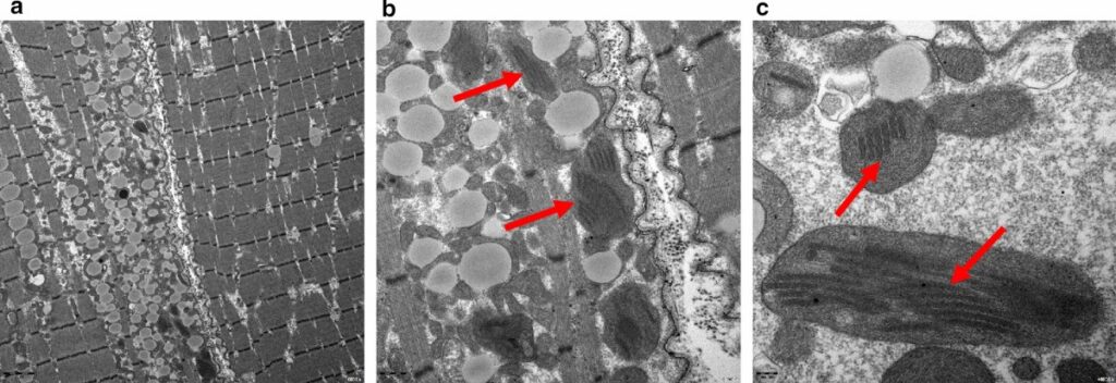 Brain MR image of a patient with MELAS syndrome